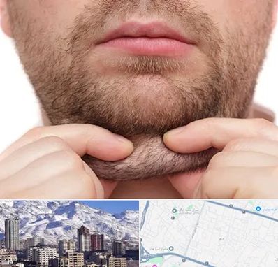 ساکشن غبغب در ازگل