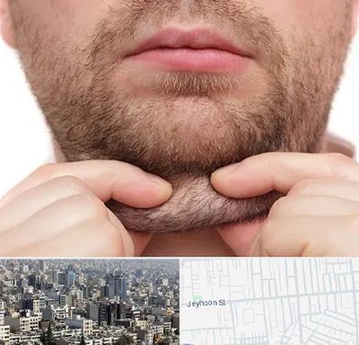 ساکشن غبغب در جیحون