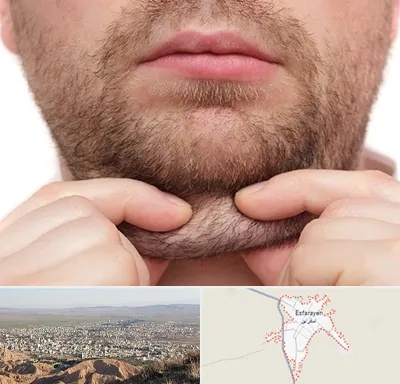 ساکشن غبغب در اسفراین