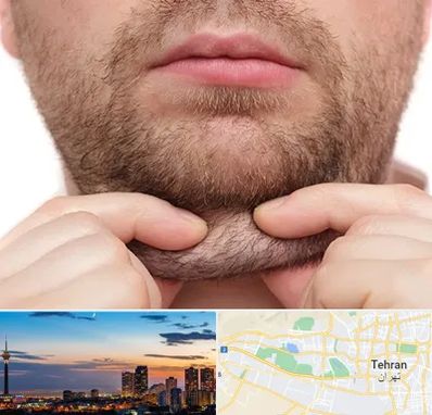 ساکشن غبغب در غرب تهران 