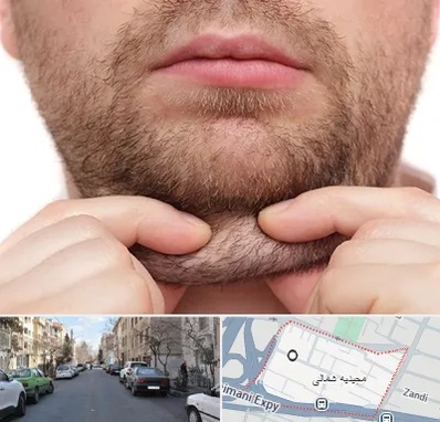 ساکشن غبغب در مجیدیه شمالی