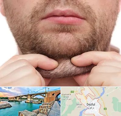 ساکشن غبغب در دزفول