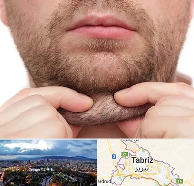 ساکشن غبغب در تبریز