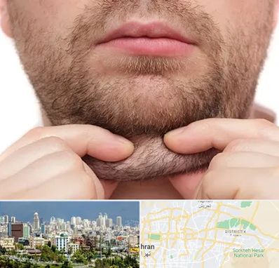 ساکشن غبغب در شرق تهران 