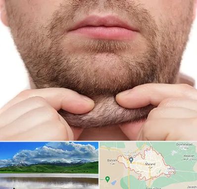 ساکشن غبغب در مرند