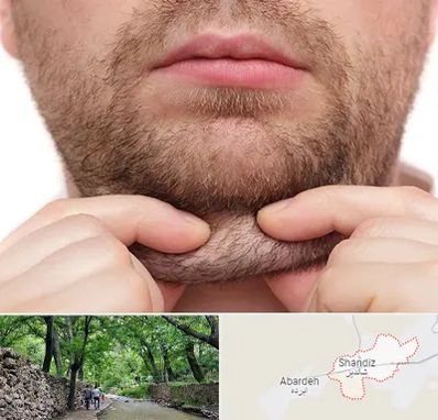 ساکشن غبغب در شاندیز مشهد