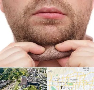 ساکشن غبغب در شمال تهران 