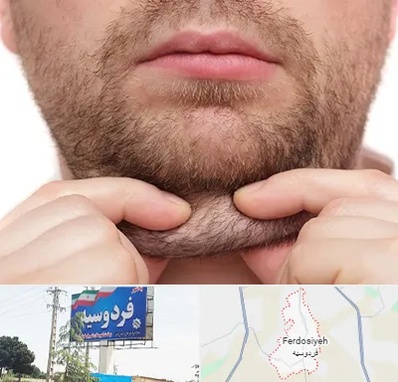 ساکشن غبغب در فردوسیه شهریار