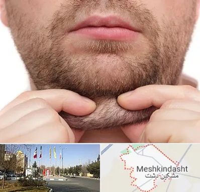 ساکشن غبغب در مشکین دشت