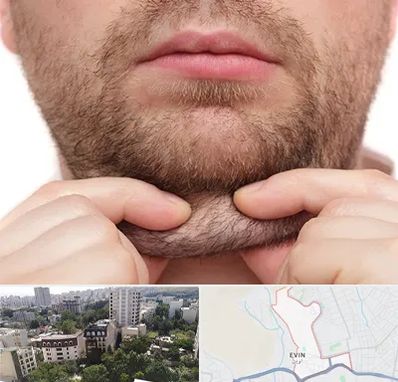 ساکشن غبغب در اوین