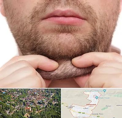 ساکشن غبغب در دماوند