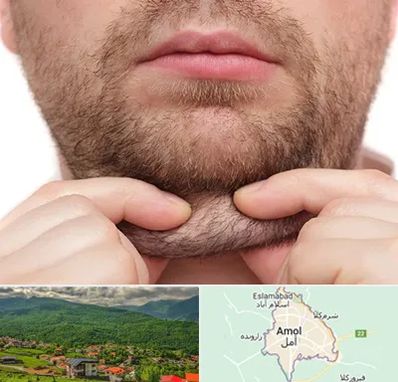 ساکشن غبغب در آمل