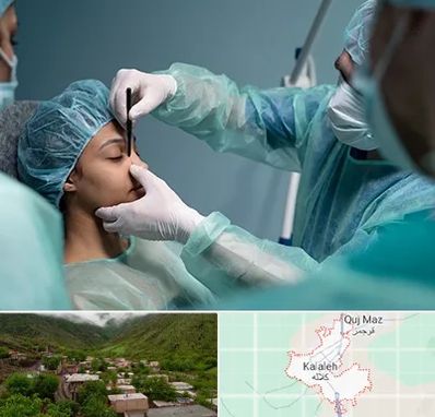 عمل بینی ارزان در کلاله