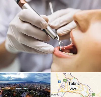 دندانپزشکی ارزان در تبریز