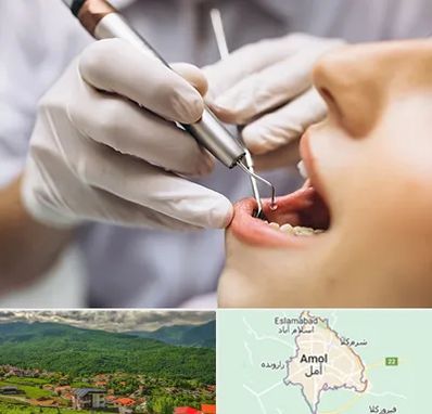 دندانپزشکی ارزان در آمل