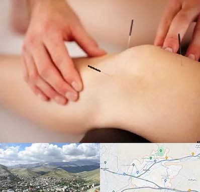 دکتر طب سوزنی برای لاغری در رودهن