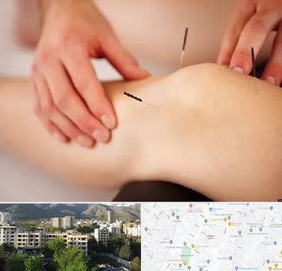 دکتر طب سوزنی برای لاغری در دیباجی 