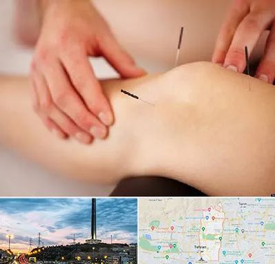 دکتر طب سوزنی برای لاغری در منطقه 2 تهران 