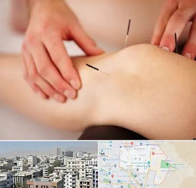 دکتر طب سوزنی برای لاغری در منطقه 14 تهران 