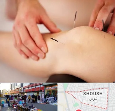 دکتر طب سوزنی برای لاغری در شوش