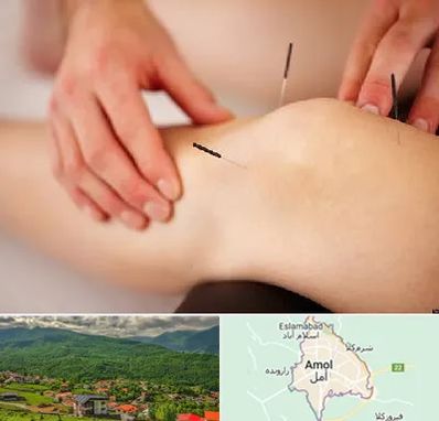 دکتر طب سوزنی برای لاغری در آمل