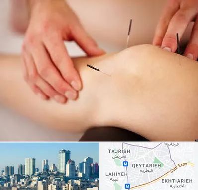 دکتر طب سوزنی برای لاغری در قیطریه 