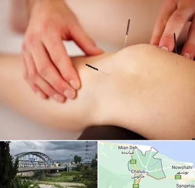 دکتر طب سوزنی برای لاغری در چالوس