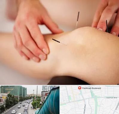 دکتر طب سوزنی برای لاغری در بلوار فرحزادی
