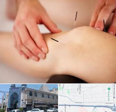 دکتر طب سوزنی برای لاغری در بلوار ابوذر