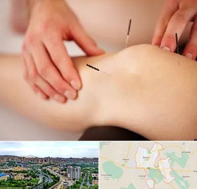 دکتر طب سوزنی برای لاغری در شهریار