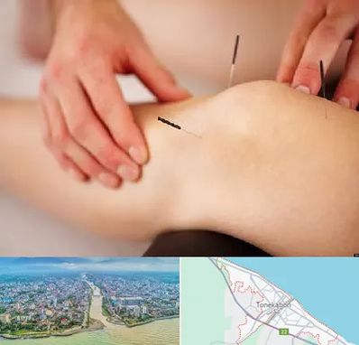 دکتر طب سوزنی برای لاغری در تنکابن
