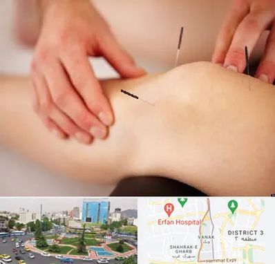 دکتر طب سوزنی برای لاغری در ونک 