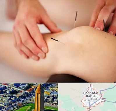دکتر طب سوزنی برای لاغری در گنبد کاووس