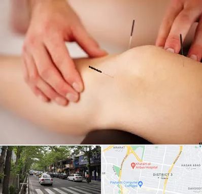 دکتر طب سوزنی برای لاغری در ظفر 