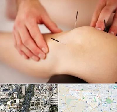 دکتر طب سوزنی برای لاغری در منطقه 18 تهران 