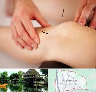 دکتر طب سوزنی برای لاغری در صومعه سرا