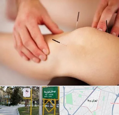 دکتر طب سوزنی برای لاغری در تهران ویلا