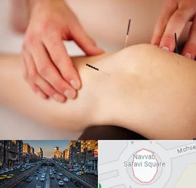 دکتر طب سوزنی برای لاغری در نواب 