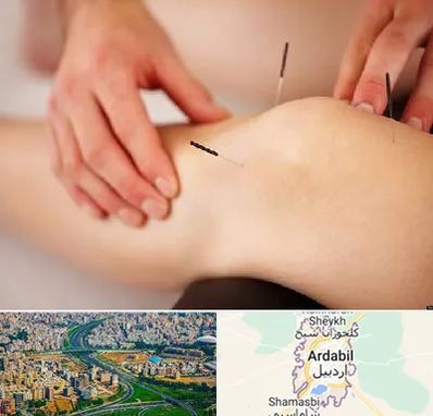 دکتر طب سوزنی برای لاغری در اردبیل