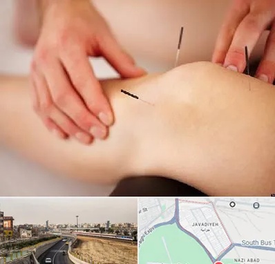 دکتر طب سوزنی برای لاغری در جوادیه