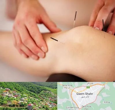دکتر طب سوزنی برای لاغری در قائم شهر