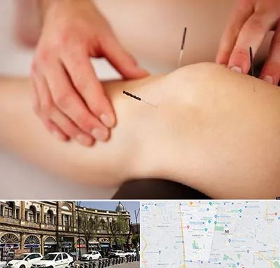 دکتر طب سوزنی برای لاغری در منطقه 11 تهران 