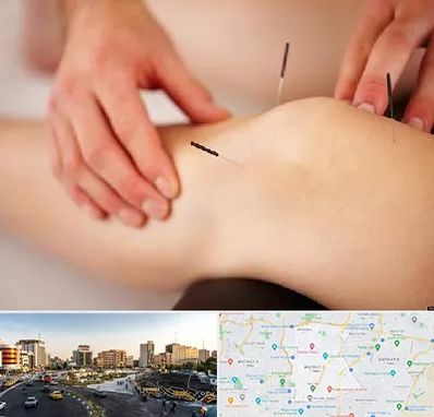 دکتر طب سوزنی برای لاغری در منطقه 7 تهران 