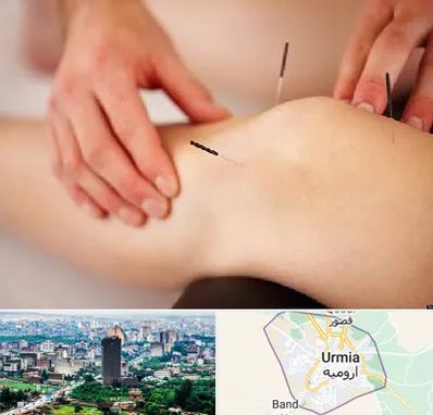 دکتر طب سوزنی برای لاغری در ارومیه