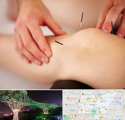 دکتر طب سوزنی برای لاغری در منطقه 3 تهران 