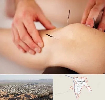 دکتر طب سوزنی برای لاغری در اسفراین