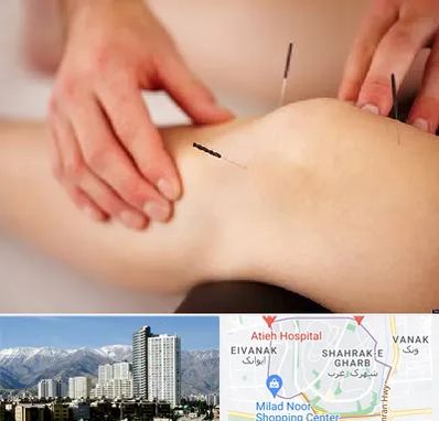 دکتر طب سوزنی برای لاغری در شهرک غرب 