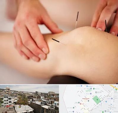 دکتر طب سوزنی برای لاغری در شمیران نو 