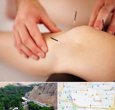 دکتر طب سوزنی برای لاغری در کن 