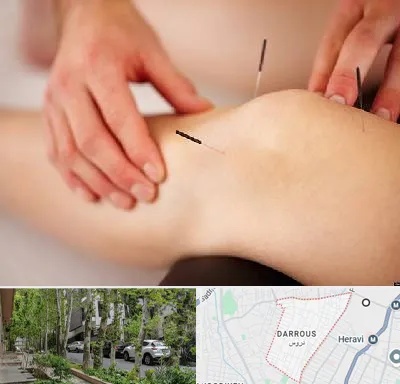 دکتر طب سوزنی برای لاغری در دروس